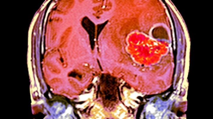 A MRI scan through the head of a 48-year-old male patient with a glioblastoma
