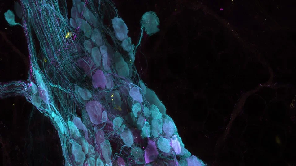 Microscopy image of the heart of a patient with coronavirus  