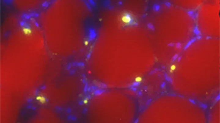 Childhood Leukemia Cells