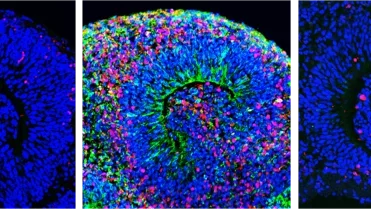 Before and After Zika Infection - Dying Stem Cells
