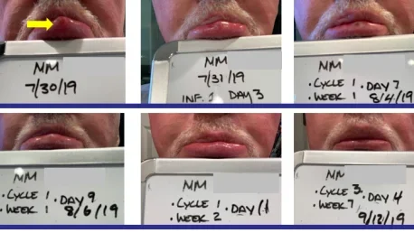 Imaging results of a patient undergoing immunotherapy for skin cancer