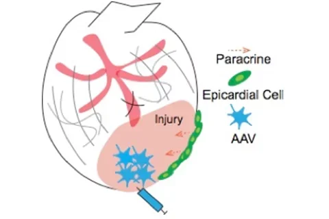 myocardial infarction