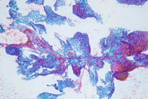 Anatomic Pathology Fine Needle Aspiration of Papillary Thyroid Carcinoma Lymph Node