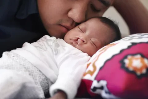 Baby with cleft lip