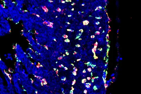Congenital heart disease