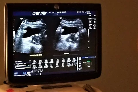 Kidney stones ultrasound