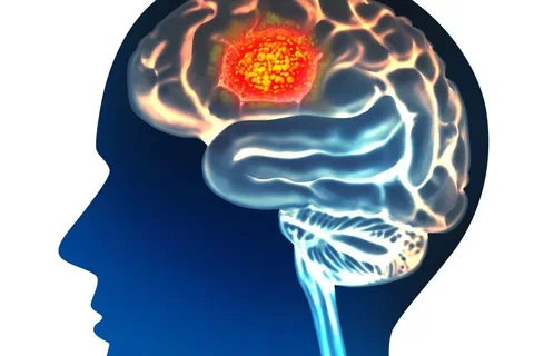 Brain cancer glioblastoma multiforme 