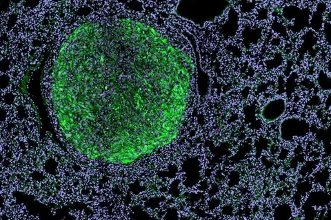 Magnified view of a kidney cancer metastasis nodule (green) within mouse lung tissue (light purple). 