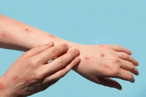 mpox