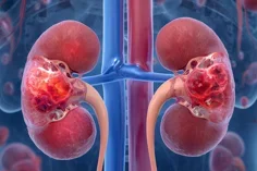 Vasculitis
