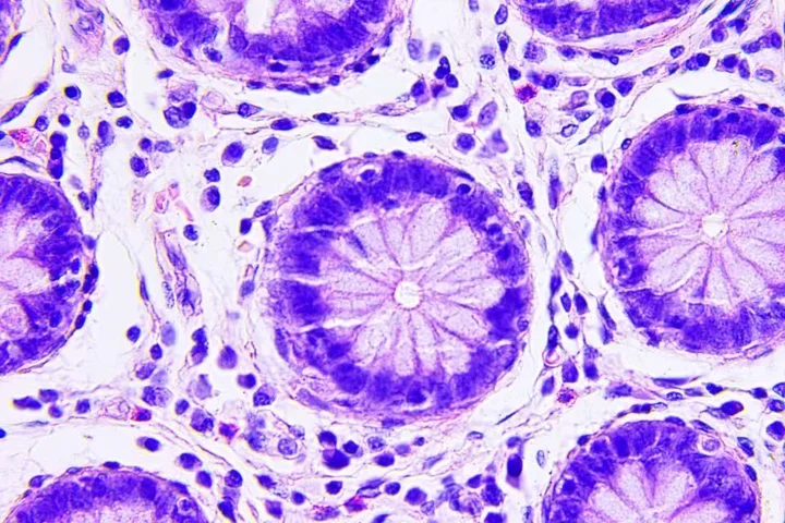 Microscopic image of colon cancer cells