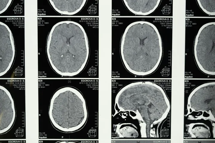 Medical Imaging of the Brain 