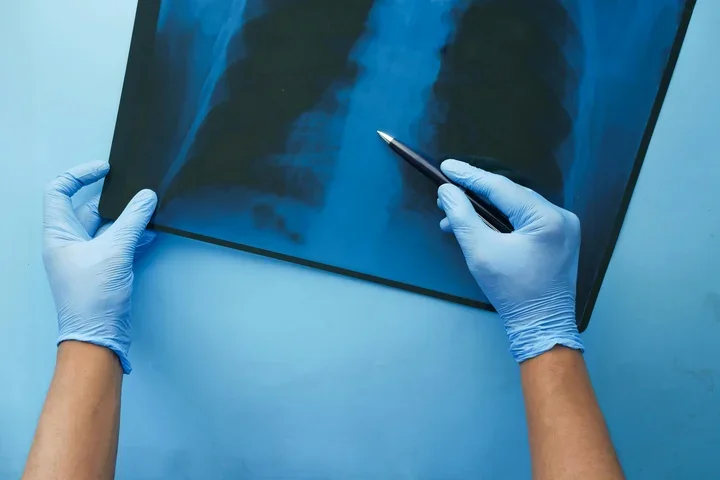 Hands pointing at lung X-ray