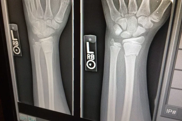 Wrist X-ray