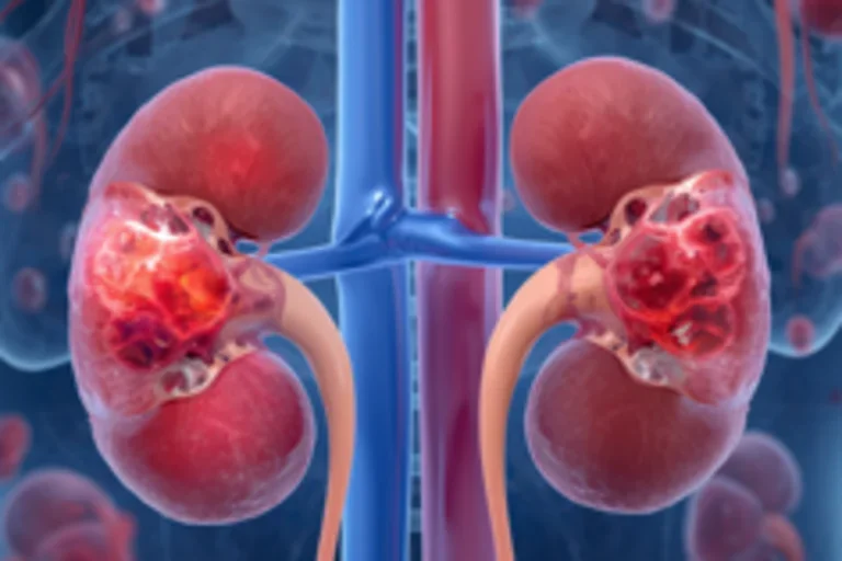 Vasculitis