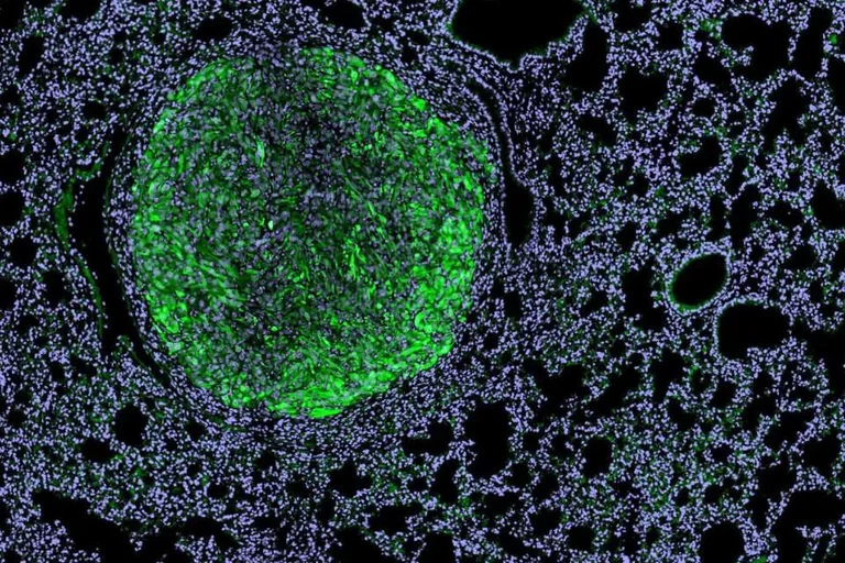 Magnified view of a kidney cancer metastasis nodule (green) within mouse lung tissue (light purple). 