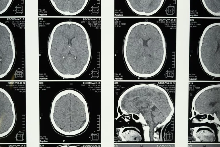 Medical Imaging of the Brain 