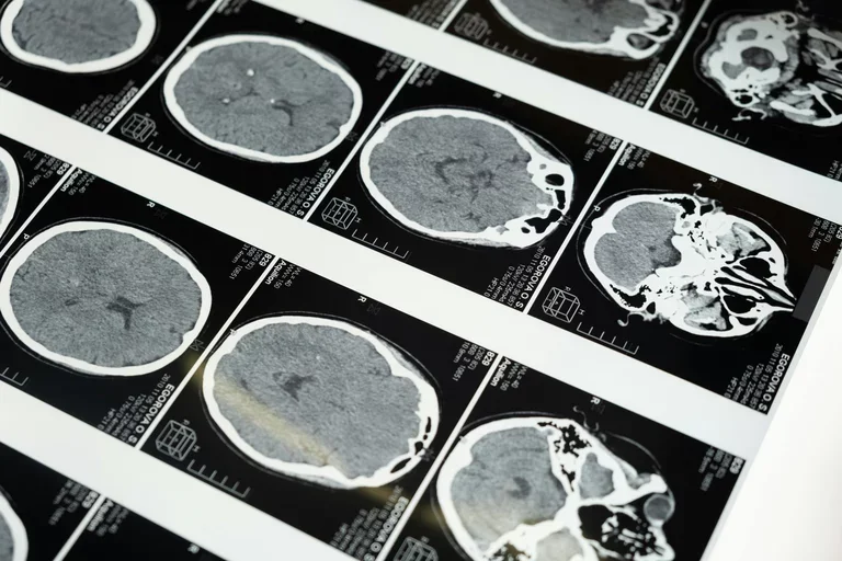 Brain MRI scane