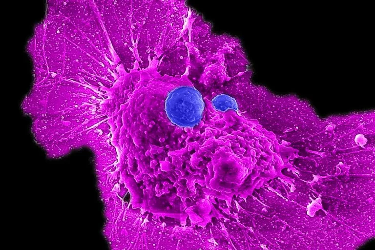 Microscopy image showing allogeneic stem cell-derived CAR-NKT cells (blue) attacking a human ovarian cancer cell (magenta). 