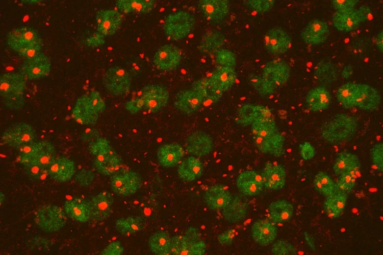 Huntington's Disease