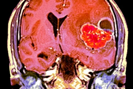 A MRI scan through the head of a 48-year-old male patient with a glioblastoma