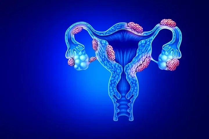 Endometriosis Treatment Image of Female Reproductive System with Endometriosis