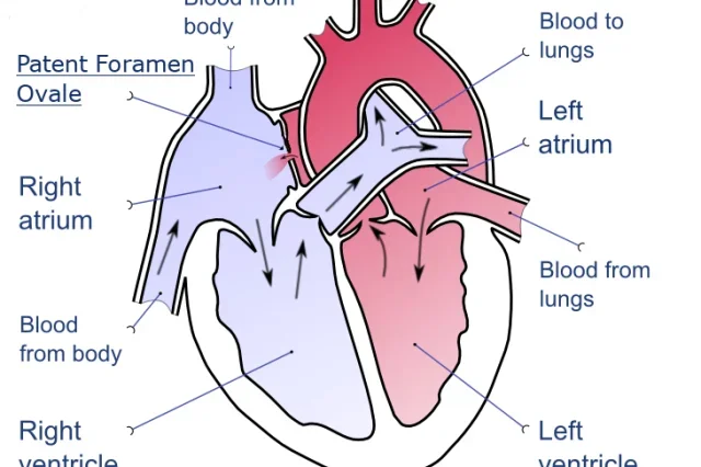 Patent foramen ovale diagram (Wikimedia Creative Commons License 3.0) 