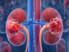 Vasculitis