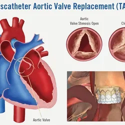 Conscious Sedation Safe Alternative Transcatheter Aortic Valve Replacement
