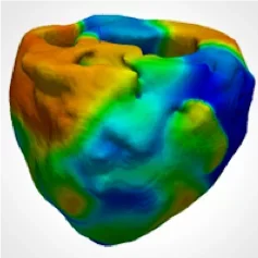 Ventricular fibrillation