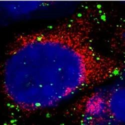 Microscopy image of atherosclerosis