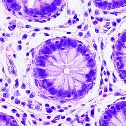 Microscopic image of colon cancer cells