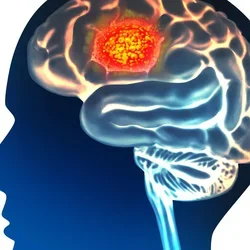 Brain cancer glioblastoma multiforme 