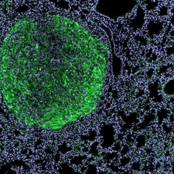 Magnified view of a kidney cancer metastasis nodule (green) within mouse lung tissue (light purple). 