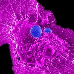 Microscopy image showing allogeneic stem cell-derived CAR-NKT cells (blue) attacking a human ovarian cancer cell (magenta). 