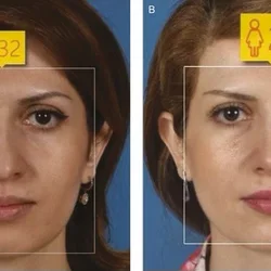 woman rhinoplasty