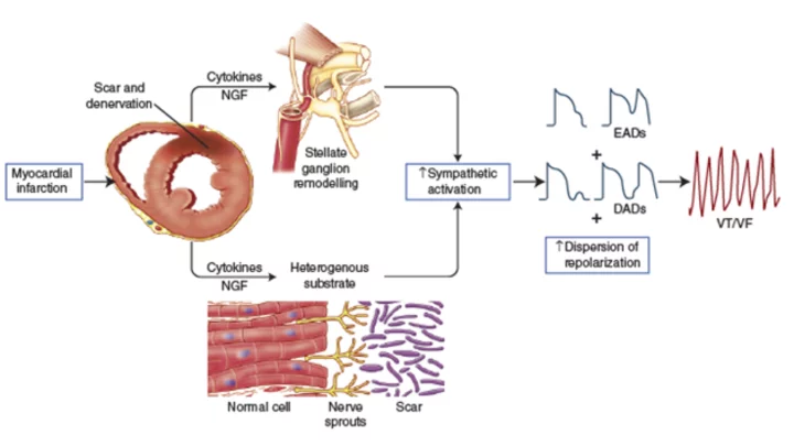 arrhythmogenesis