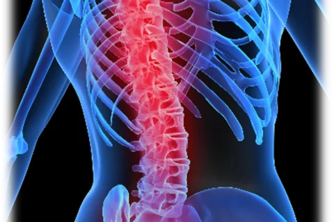 Spine inflammation on skeleton 