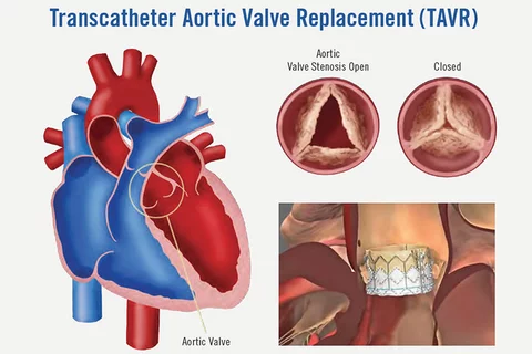 Conscious Sedation Safe Alternative Transcatheter Aortic Valve Replacement