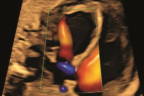 Fetal Sonogram
