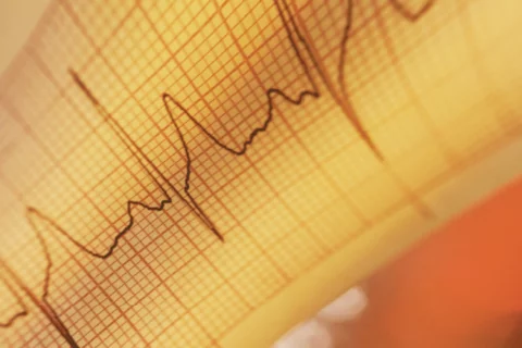 EKG Photo
