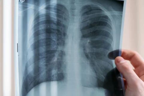 Lung X-Ray
