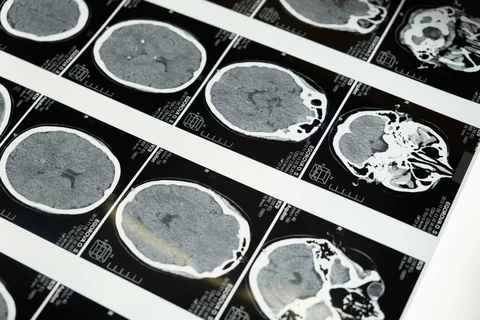 Brain MRI scane