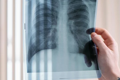 Lung X-Ray