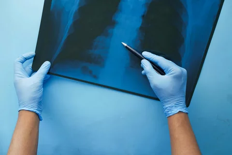 Hands pointing at lung X-ray