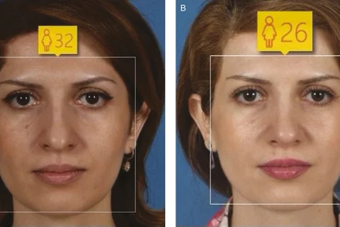 woman rhinoplasty