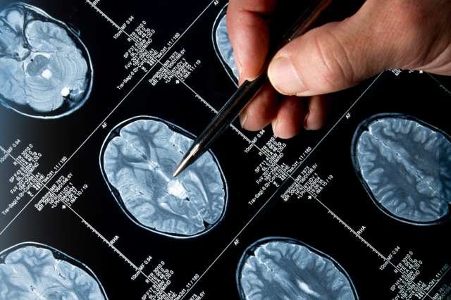 Epilepsy Diagnosis Closeup of Brain Activity and Seizure Data