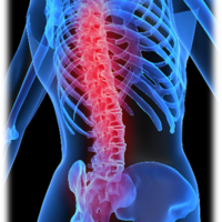 Spine inflammation on skeleton 