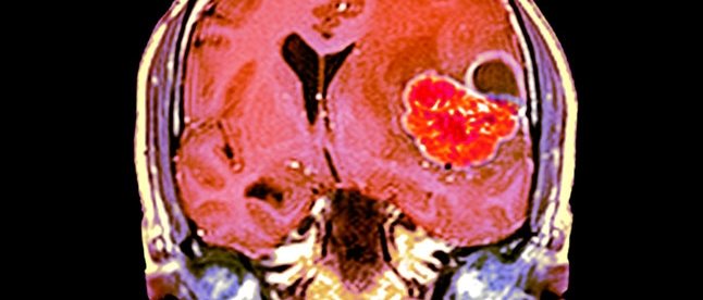 A MRI scan through the head of a 48-year-old male patient with a glioblastoma