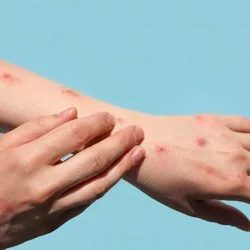 mpox 